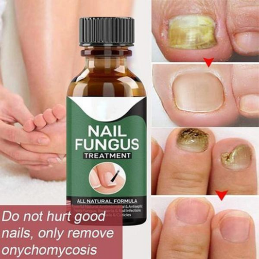Hypoallergenic Nail Fungus Treatment Serum-1PC For Effective Health